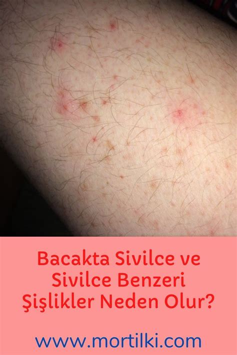 erkeklerde bacaklarda sivilce neden çıkar